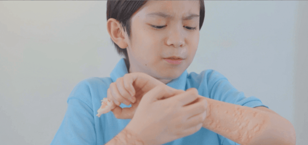 Punya Alergi? Kenali 4 Gejalanya