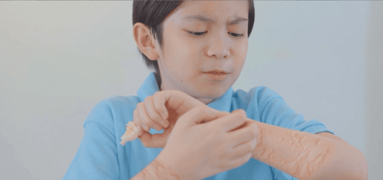 Punya Alergi? Kenali 4 Gejalanya