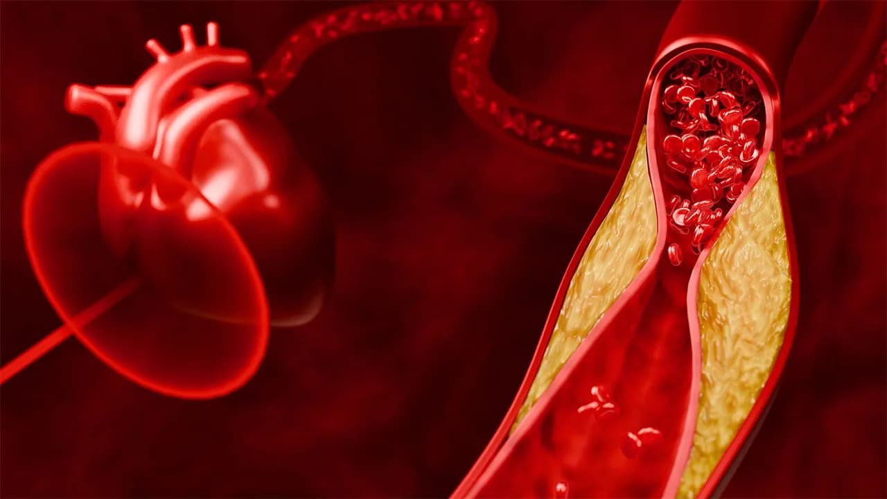 Penyebab dan Faktor Risiko Dislipidemia, Berhentilah Merokok