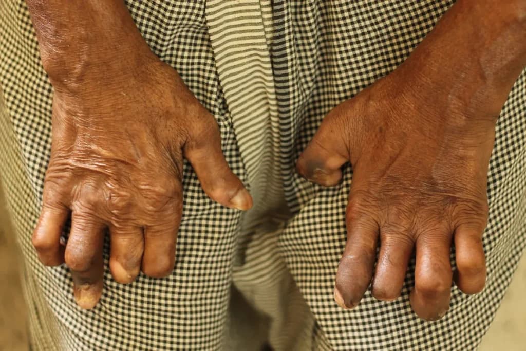 Stigma Kusta Penyakit Kutukan yang Sebenarnya Bisa Sembuh