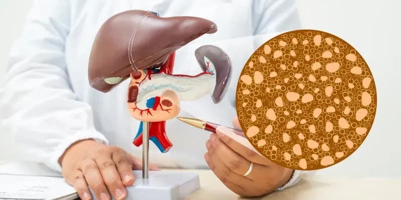 Fatty Liver Mulai Intai Usia 30-an, Pentingnya Perbaikan Gaya Hidup